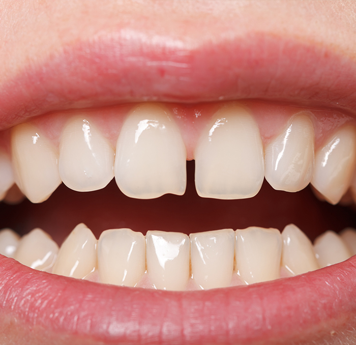 Closeup of smile with chipped tooth before dental bonding