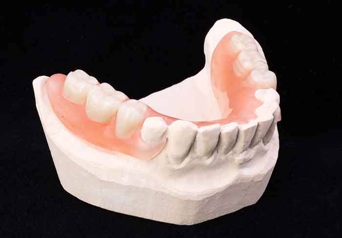 a partial denture on a plaster model of a mouth