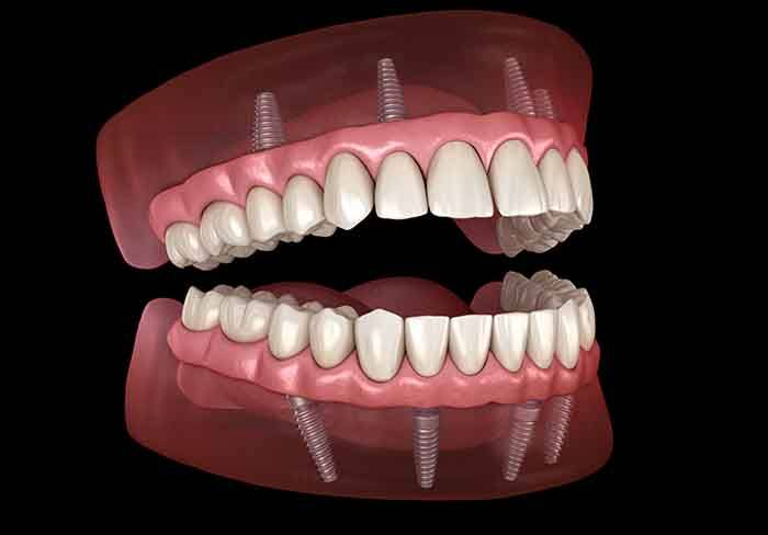 a computer illustration of implant dentures