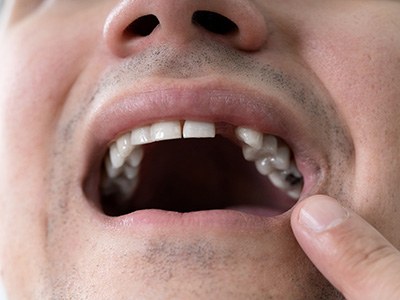 Man with a missing tooth