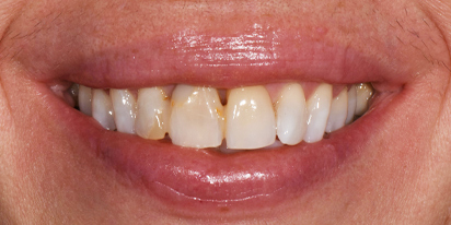 Closeup of discolored smile before dental treatment