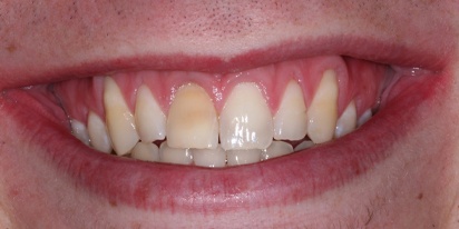 Closeup of smile with gum tissue recession