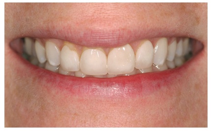 Closeup of flawless smile after cosmetic dental treatment in Buda