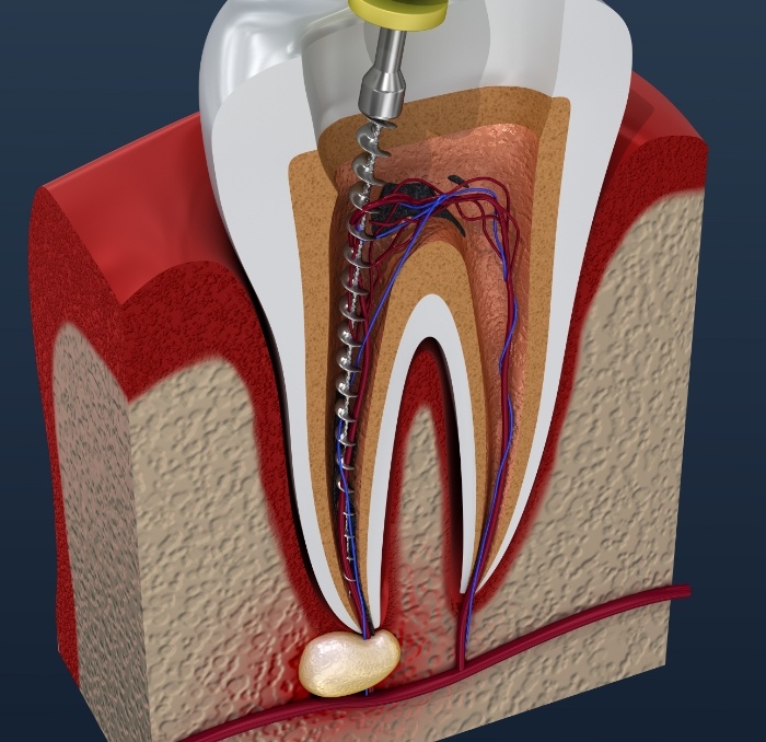 Animated tooth during root canal treatment